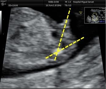13 gender weeks at ultrasound Boy or